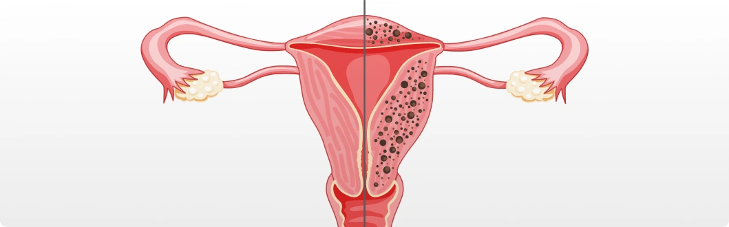 Adenomyosis