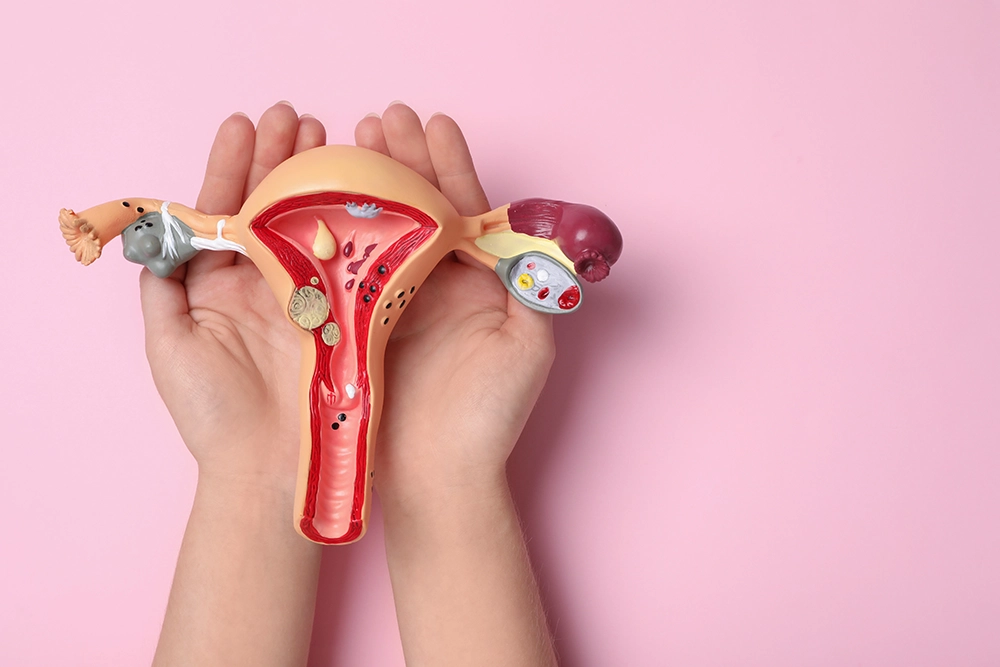 Woman holding an anatomical model of the uterus to illustrate uterine fibroids.