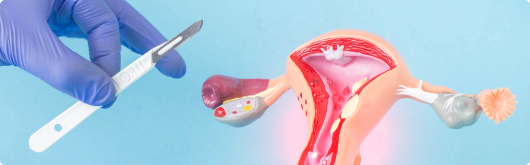 Myomectomy (Fibroid Removal)